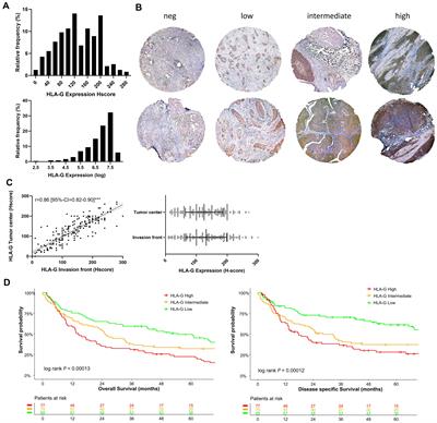 HLA-G expression associates with immune evasion muscle-invasive urothelial cancer and drives prognostic relevance